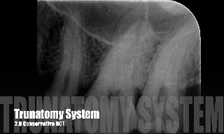 Se muestra el tratamiento de conductos del diente 2.6 mediante una apertura cameral m&iacu