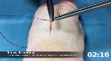 T&eacute;cnica de la sutura discont&iacute;nua para la aproximaci&oacute;n de 