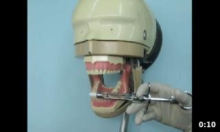 El método directo consiste en introducir la aguja desde premolares contralaterales 