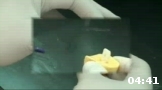 Tratamiento de conductos de un incisivo maxilar