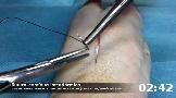 T&eacute;cnica de la sutura cont&iacute;nua intrad&eacute;rmica, para la aprox