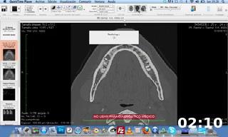 Localizar el nervio dentario con Osirix